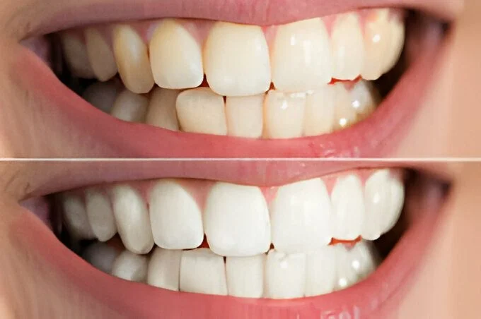 Teeth whitening treatment