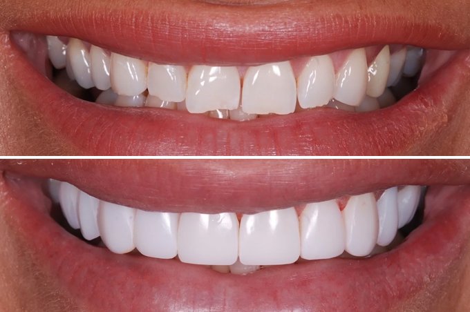Composite Bonding
