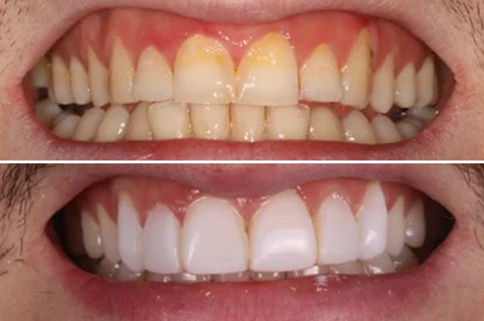 Composite Bonding treatment
