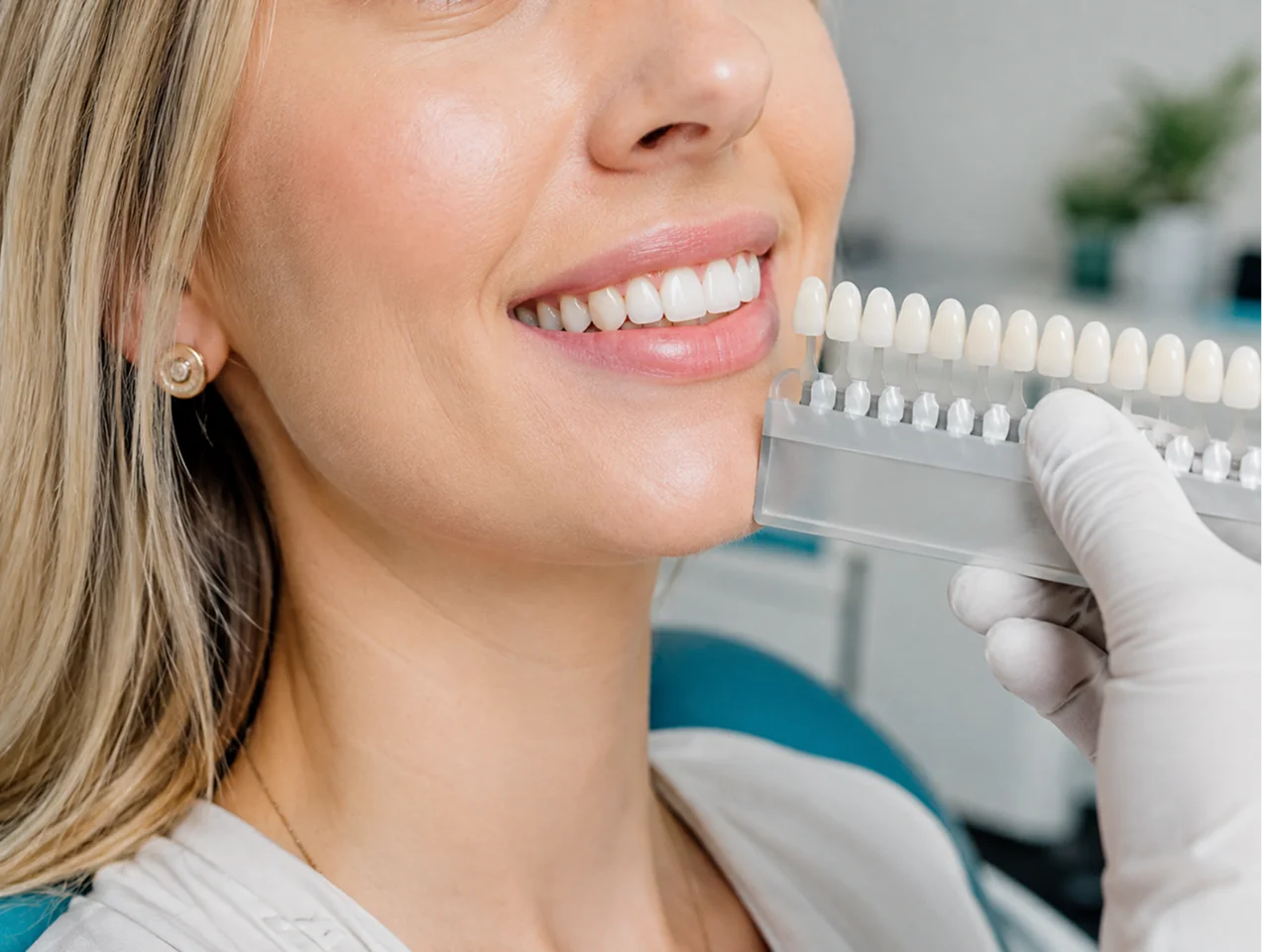 Bright, even smile after cosmetic veneers and whitening